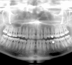 Dental X-ray picture